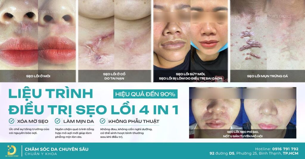 Khám phá công nghệ trị sẹo đỉnh cao tại Dr. Choice Clinic 4
