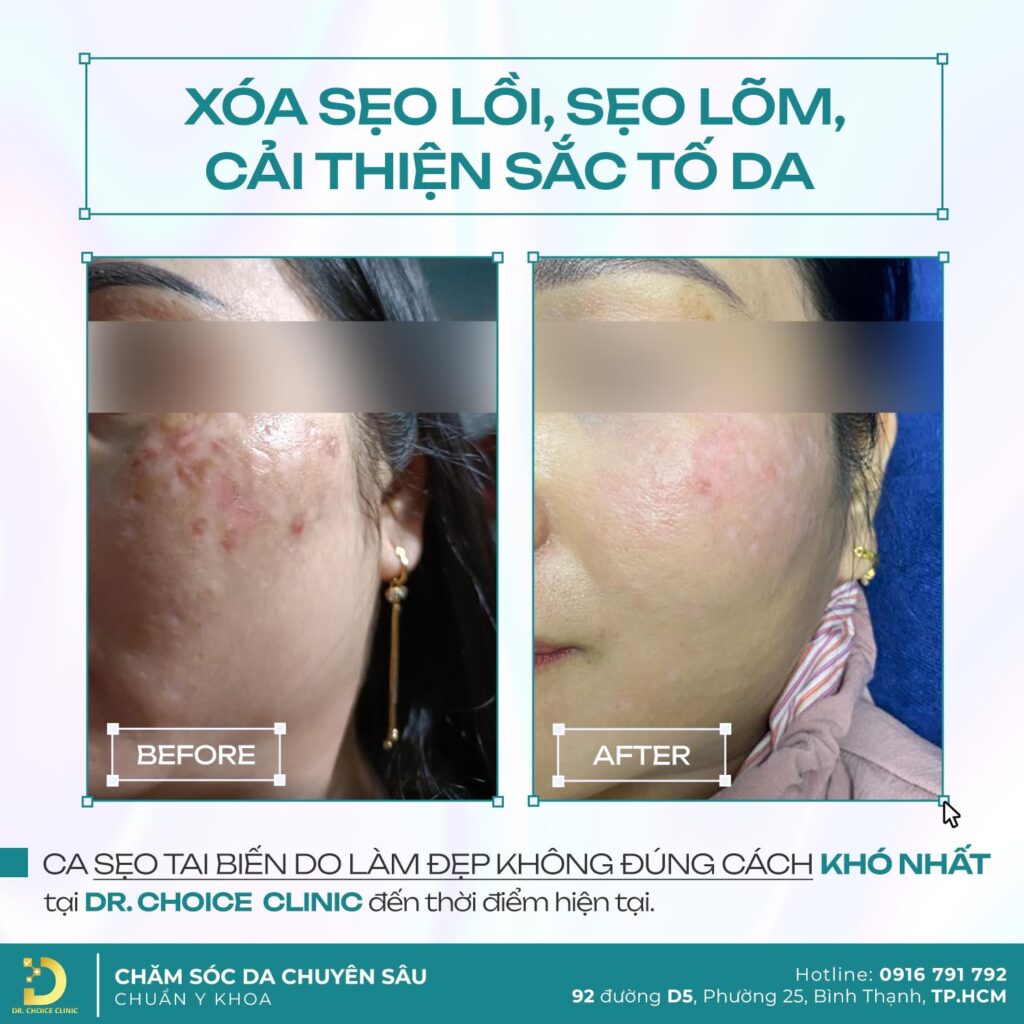 Khám phá công nghệ trị sẹo đỉnh cao tại Dr. Choice Clinic 9
