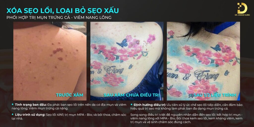 Khám phá công nghệ trị sẹo đỉnh cao tại Dr. Choice Clinic 13