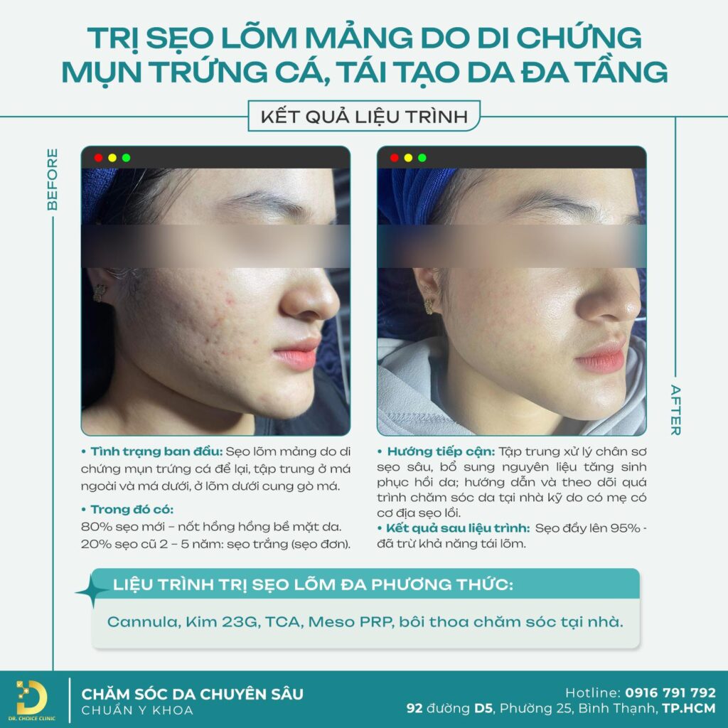 Khám phá công nghệ trị sẹo đỉnh cao tại Dr. Choice Clinic 7