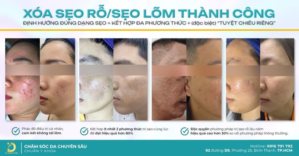 Khám phá công nghệ trị sẹo đỉnh cao tại Dr. Choice Clinic 8